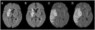 Spatial normalization for voxel-based lesion symptom mapping: impact of registration approaches